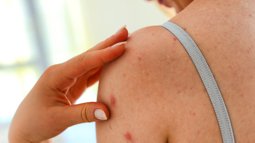 Example of light shingles rash and blisters on a woman's shoulder.