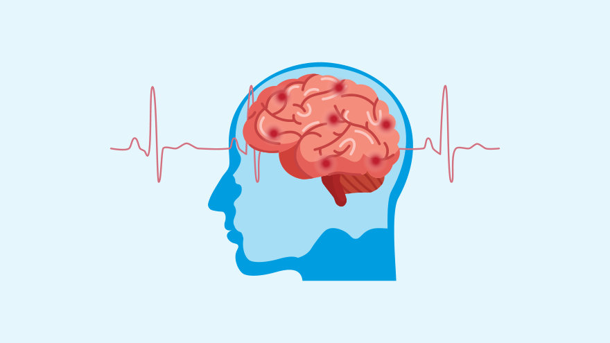Profile of a human head with a stylized brain. Multiple red points appear around the brain, symbolizing blood clots. A red EKG line appears through he middle of the brain.